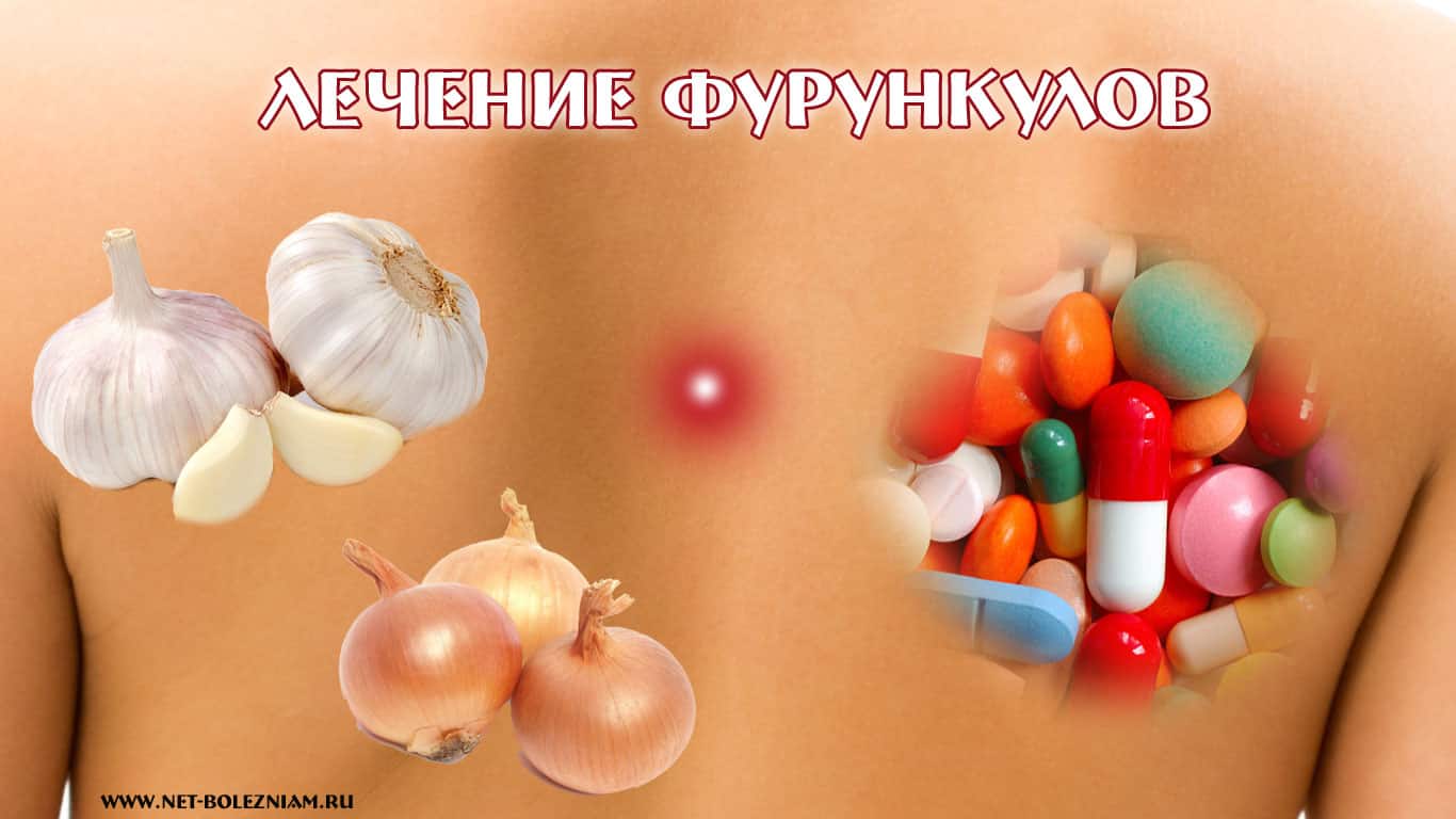 Лечение фурункулов