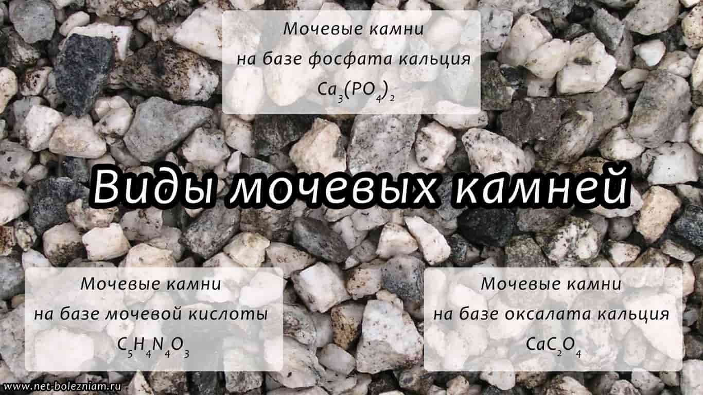 Виды мочевых камней